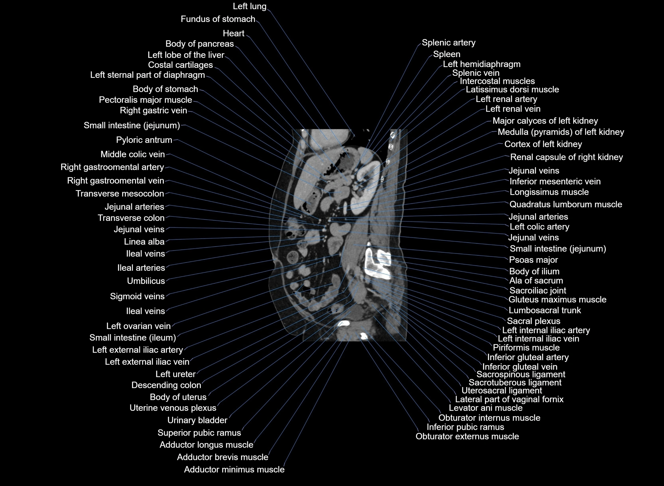 CT Abdomen sagittal cross sectional anatomy labelled radiology image -00045.webp